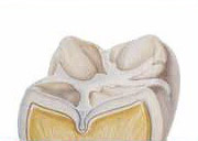 Dental sealants can be used to cover the grooves in teeth to prevent cavities from forming